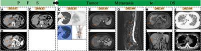 Case report: A rare DLST mutation in patient with metastatic pheochromocytoma: clinical implications and management challenges